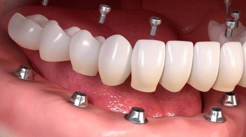 The Long-Term Gains of Choosing Dental Implants Over Other Tooth Replacement Solutions